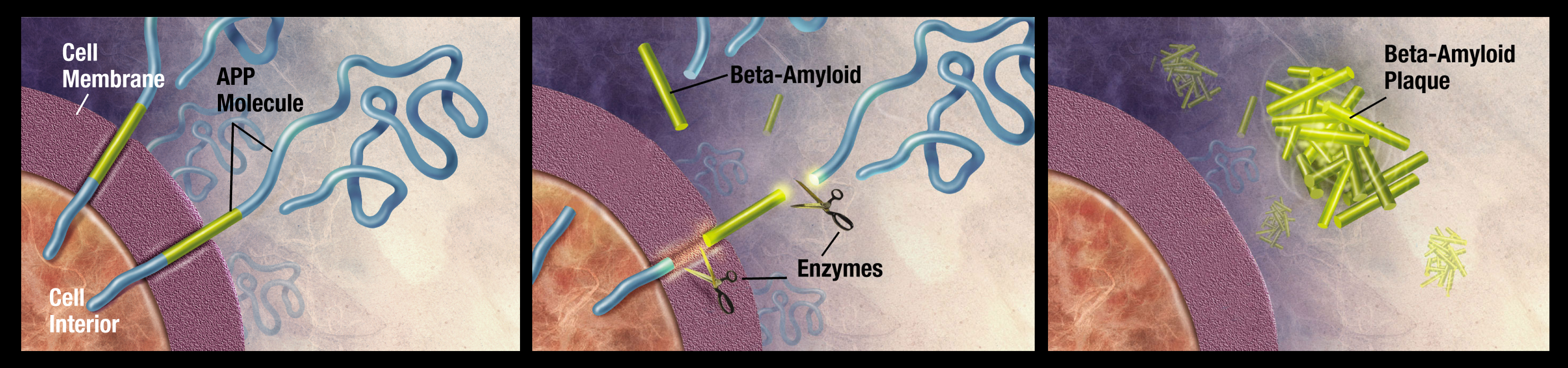 Схематично представяне на формирането на бета-амилоида и бета-амилоидните плаки. APP е прекурсорът на бета-амилоидния протеин (жълто).