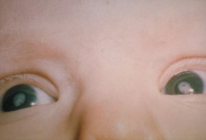 cataracts_congenital