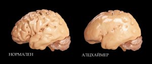 Болестта е съпроводена с атрофия на мозъчната кора и загуба на гънките в определени части на мозъка. Credit: Doctor Jana (CC BY 4.0)