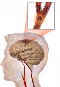 Илюстрация на исхемичен инсулт - съсирекът е запушил кръвоносния съд. Blausen Medical Communications, Inc (CC BY 3.0) 