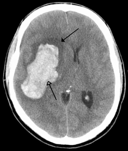 Компютърно-томографско изображение на интрапаренхимен кръвоизлив (долна стрелка) и обграждащият го оток (горна стрелка). Credit: James Heilman, MD, (CC BY-SA 3.0) 