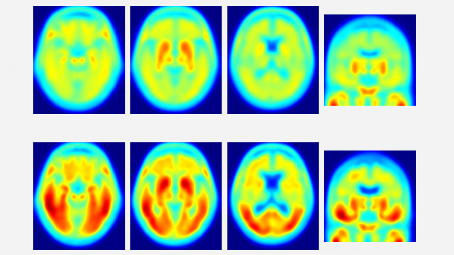 PET изображения, показващи депозити от тау-протеин в мозъка на индивиди болни от болестта на Алцхаймер (долен ред) и на здрави индивиди (горен ред). Регионите в червено показват натрупване на тау-протеин. Credit: Dr. Matthew Brier