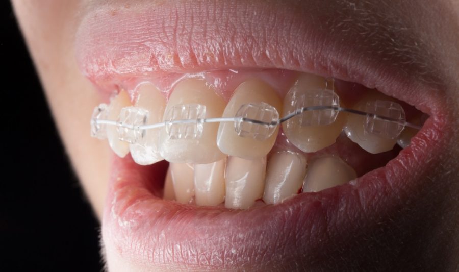 Снимка 5. Сапфирени брекети поставени на горната зъбна редица (27)