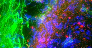 Тази микроскопска снимка показва как се изгражда белтъкът алфа синуклеин (в червено) в нервни клетки (в синьо) в мозък, поразен от болестта на Паркинсон. Ново изследване установява, че имунната система може да реагира на част от молекулата на белтъка. Roger J. Bick & Mya C. Schiess/UT-Houston Medical School/Science Source