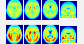 PET изображения, показващи депозити от тау-протеин в мозъка на индивиди болни от болестта на Алцхаймер (долен ред) и на здрави индивиди (горен ред). Регионите в червено показват натрупване на тау-протеин. Credit: Dr. Matthew Brier