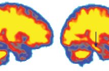 Акумулация на амилоид-бета (в жълто) в мозъка на добре отпочинали хора (вляво) и на хора, прекарали без сън 31 часа (вдясно). Със стрелка е отбелязано повишено количество амилоид-бета в хипокампуса. Credit: E. SHOKRI-KOJORI/NIH